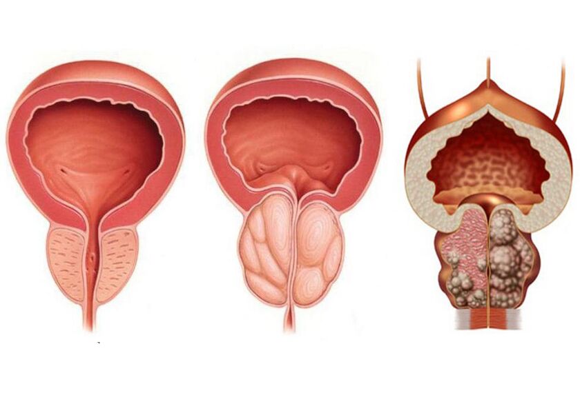 Stades de la prostatite et nécessité d'un traitement avec Prostavit