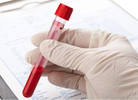 Avec des méthodes de diagnostic de laboratoire, vous pouvez identifier la microflore ou le virus pathologique