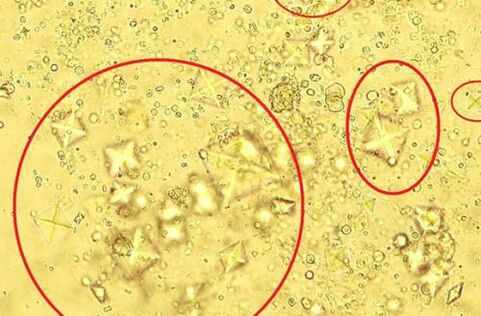 Voici à quoi ressemblent les cristaux de sel contenus dans l'urine au microscope dans la prostatite calculeuse