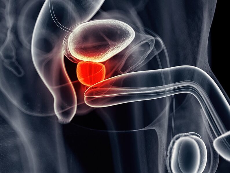 Inflammation de la prostate comme effet secondaire de la prostatite chronique